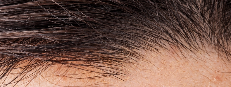 FUE (Follicular Unit Extraction)